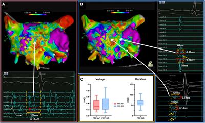 Validating left atrial fractionation and low-voltage substrate during atrial fibrillation and sinus rhythm—A high-density mapping study in persistent atrial fibrillation